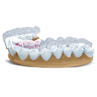 Evident Aligners  Evident Aligners gives you the opportunity to print in house with our planning services, or have our team manufacture the aligners for your patient.      Evident Aligners  Evident can help you plan your case for in office manufacturing or alternatively evident can manufacture for you. The choice is yours.   What we need:   Clean STL scans: upper and/or lower and bite Aligner photo set (see attached image. Please add into this section)   What you will get if we are ONLY PLANNING FOR YOU:   Case viewer for approval Once approved, complete set of STL model files for in house manufacturing   What you will get if we are FABRICATING FOR YOU:   Case viewer for approval Patient ready manufactured aligners including bonding tray for attachments if required    Learn More