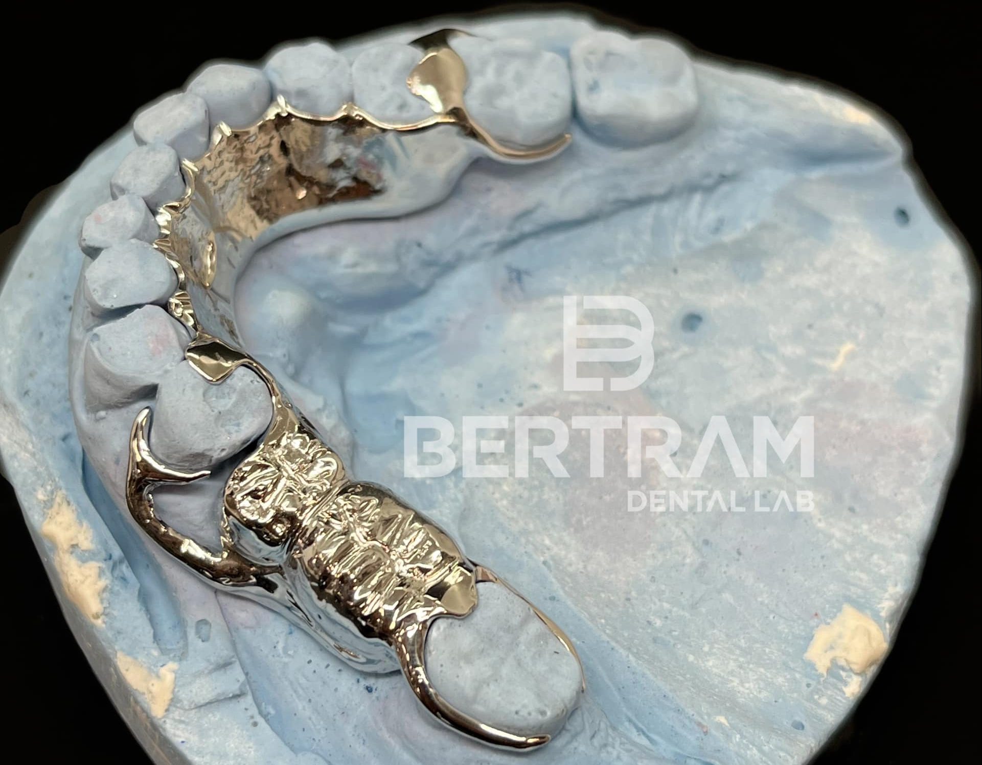 Bertram Dental Lab's Removable Partial Denture